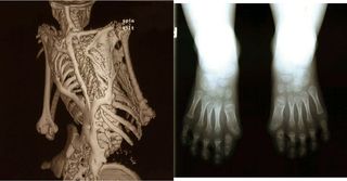 FOP features skeletal and toes